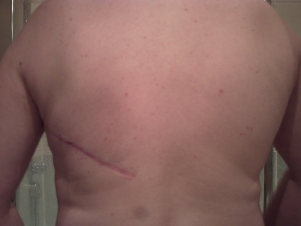 scar_on_back__by_lightningtremlett.jpg